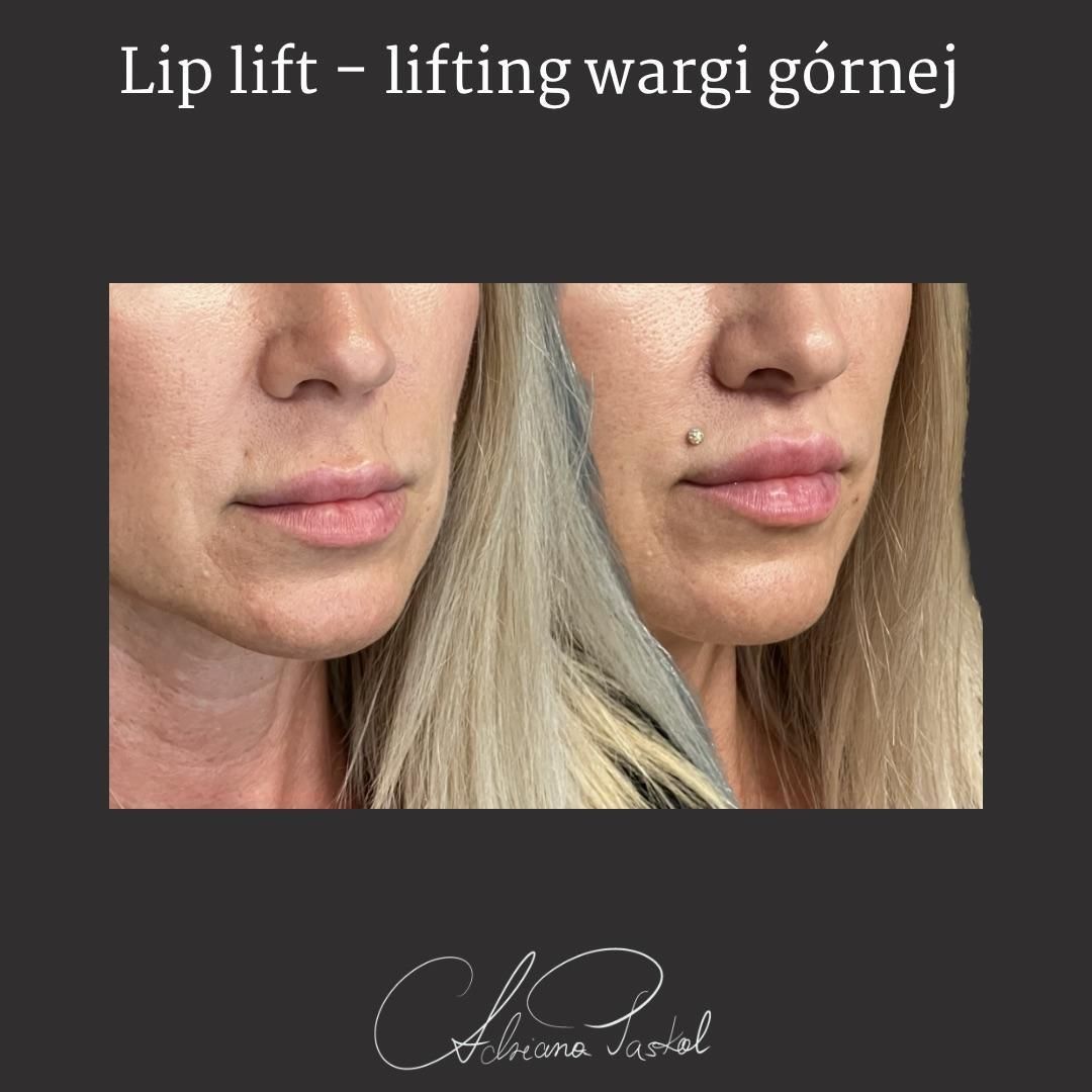 Bullhorn lip lift