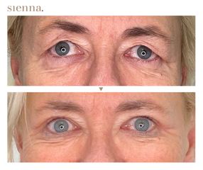 Blefaroplastyka - Klinika Sienna