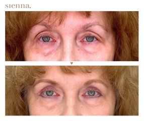 Blefaroplastyka - Klinika Sienna