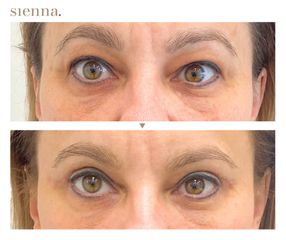Blefaroplastyka - Klinika Sienna