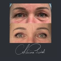 Blefaroplastyka - dr n. med. Adriana Paskal