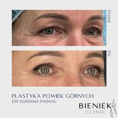 Blefaroplastyka - dr n. med. Adriana Paskal
