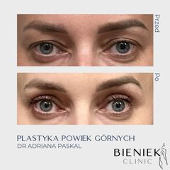 Blefaroplastyka - dr n. med. Adriana Paskal