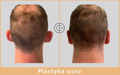 Plastyka uszu - dr n. med. Michał Chalcarz
