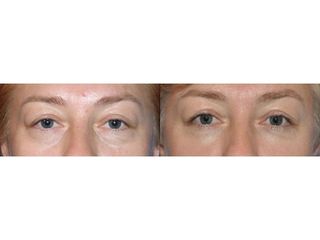 Przed i po: blefaroplastyka