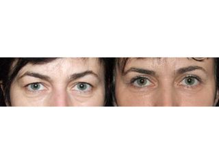 Przed i po: blefaroplastyka